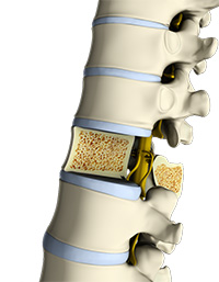 Osteoporosis