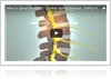 A Look at Lumbar Spinal Stenosis