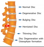 Exploring the Treatment Options for Degenerative Disc Disease