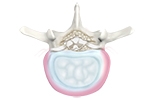 One third of people aged 40-59 have evidence of degenerative disc disease