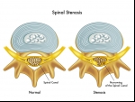 The Patient's Guide to Laminotomy for Spinal Stenosis