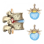 What Are Some of the Most Common Reasons for Revision Spine Surgery?