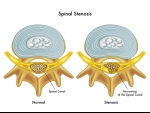 What Are the Symptoms of Spinal Stenosis?