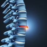 What Complications Are Associated with Herniated Discs?