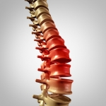 What Conditions Reduce the Width of Your Spinal Column