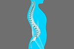 What to know about hyperlordosis