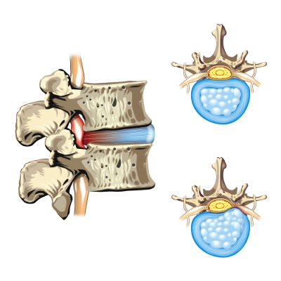 Spine Surgeon Near Miami