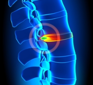 illustration of herniated disc